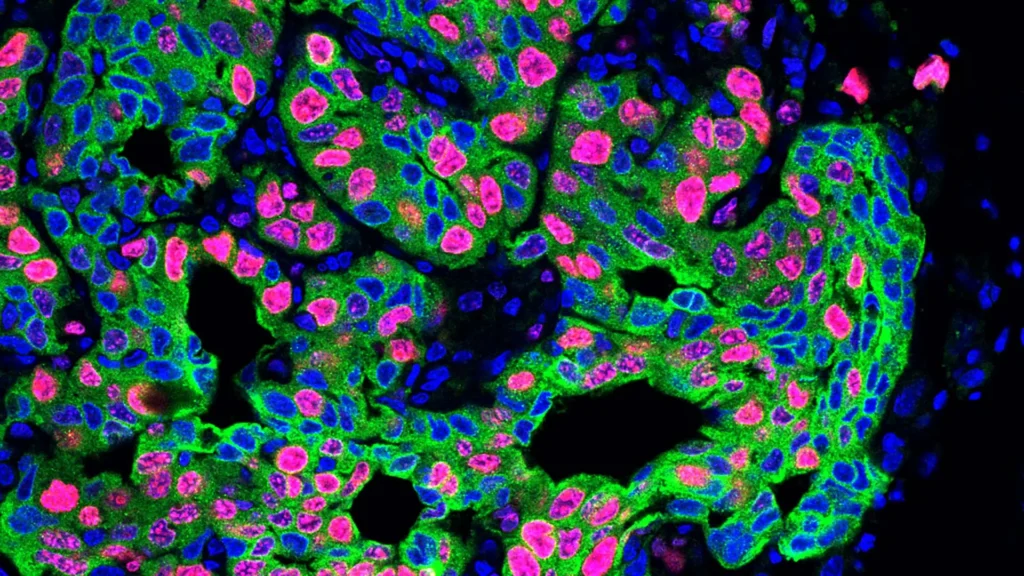 Léčba rakoviny - metastázované buňky