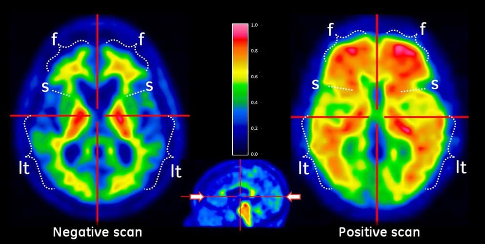 Skeny mozku s vyznačenými oblastmi. Levý sken označený jako "Negative scan" ukazuje normální mozkovou aktivitu s převládající modrou a zelenou barvou. Pravý sken označený jako "Positive scan" ukazuje zvýšenou mozkovou aktivitu s převládajícími červenými a oranžovými barvami. Na skenech jsou označeny oblasti: f (frontální), s (spánková), a lt (laterální). Střední sken zobrazuje řezy mozku ve třech rovinách.