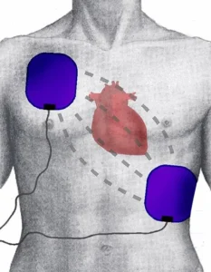 Umístění elektrod pro zevní elektrickou kardioverzi v anterolaterální pozici. Dvě elektrody jsou připevněny na hrudníku pacienta, jedna nahoře vlevo, druhá vpravo dole, srdce je znázorněno uprostřed.