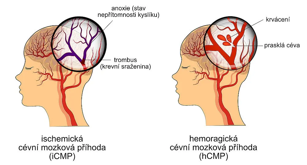 Schéma ukazující rozdíly mezi ischemickou a hemoragickou cévní mozkovou příhodou. Obrázek znázorňuje krevní sraženinu blokující průtok krve a prasknutí cévy vedoucí ke krvácení.