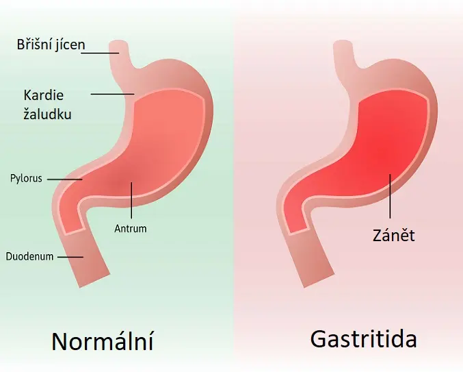 Porovnání normálního žaludku a žaludku s gastritidou, zvýrazněné části anatomie žaludku: jícen, kardie, pylorus, duodenum a místo zánětu.