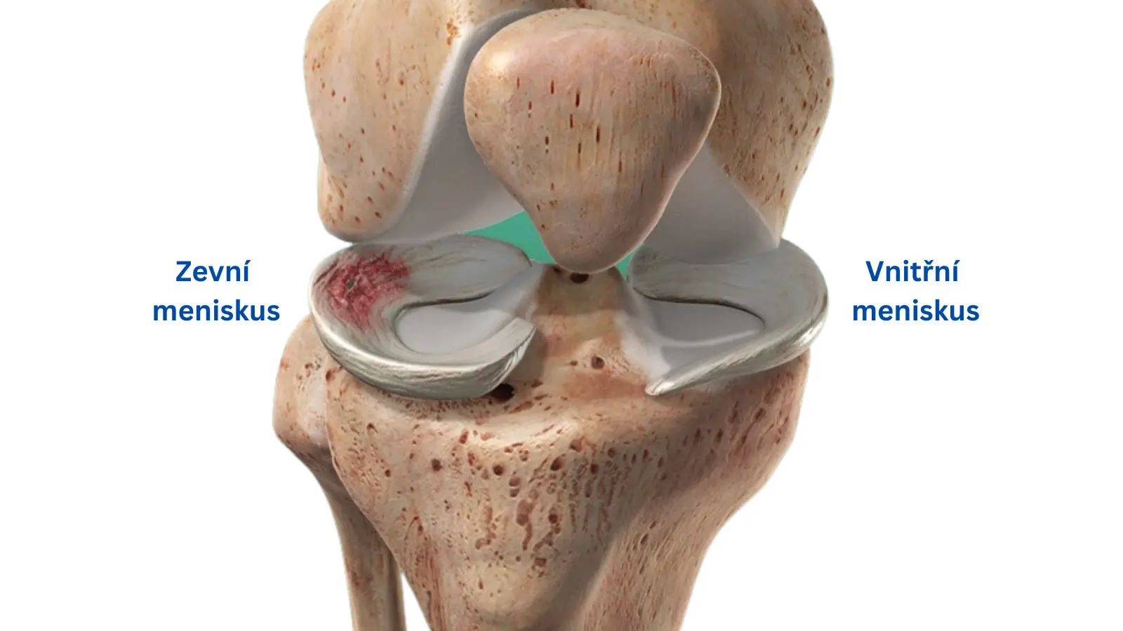 Detailní zobrazení kolenního kloubu s označením vnějšího (laterálního) a vnitřního (mediálního) menisku, znázorňující chrupavčité struktury mezi stehenní a holenní kostí.